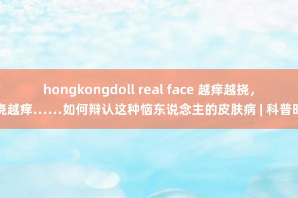 hongkongdoll real face 越痒越挠，越挠越痒……如何辩认这种恼东说念主的皮肤病 | 科普时刻